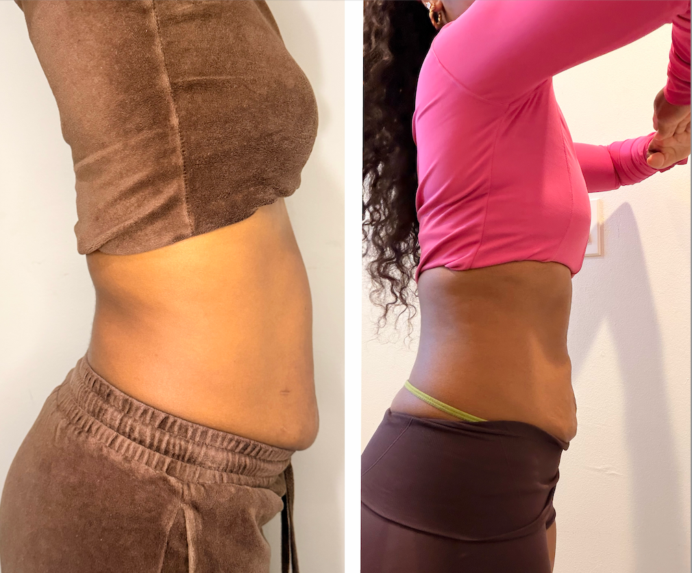 Refined Mommy Makeover 3 sessions