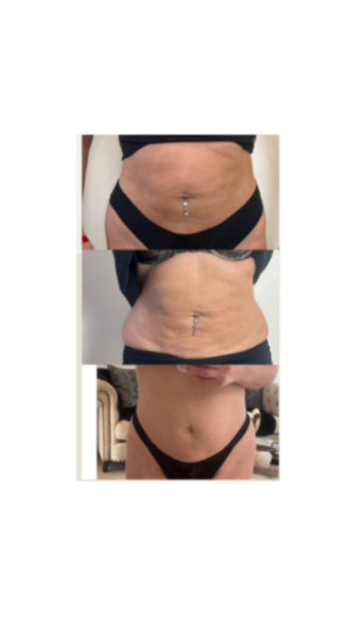 Refined Mommy Makeover 3 sessions